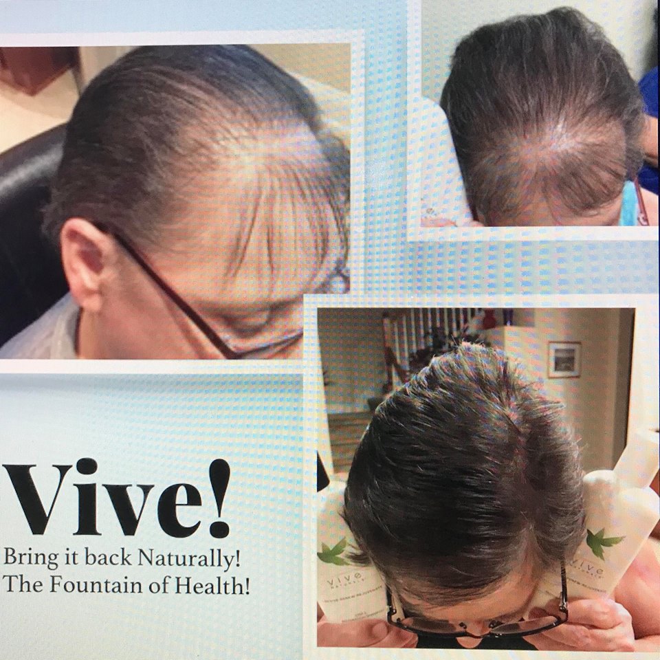 Vive Naturals Hair Restoration Treatment – Complete 3-Step System